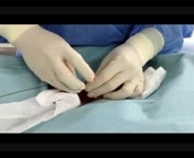 Tindakan kateterisasi otak tehnik SELDINGER PUNCTURE